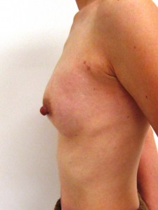 術後1ヶ月　左側面